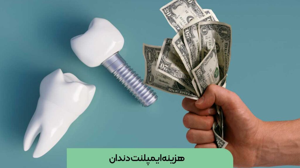 هزینه ایمپلنت دندان