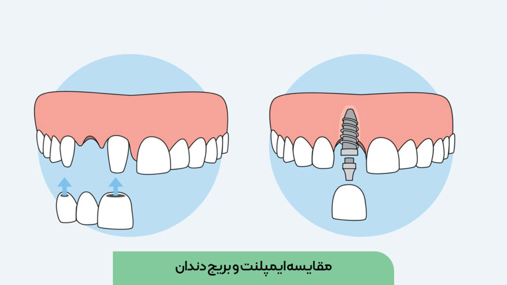 مقایسه ایمپلنت و بریج دندان