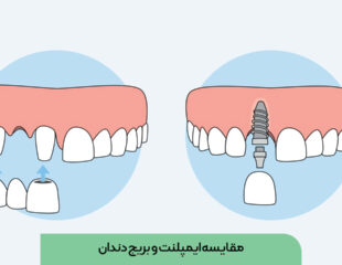 مقایسه ایمپلنت و بریج دندان