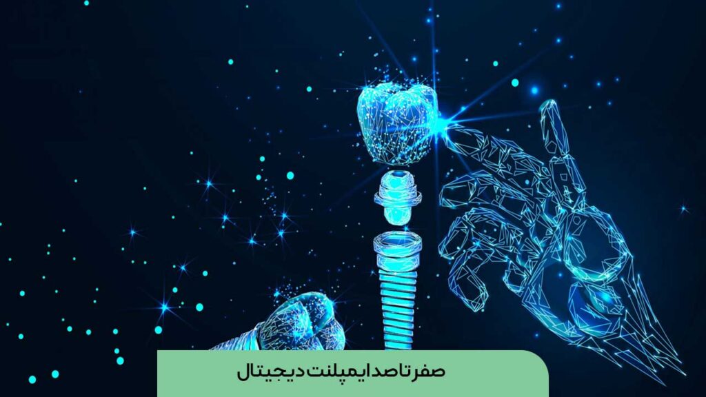 ایمپلنت دیجیتال