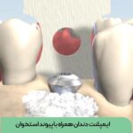 ایمپلنت دندان همراه با پیوند استخوان فک