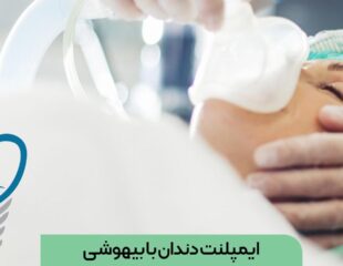 ایمپلنت دندان با بیهوشی